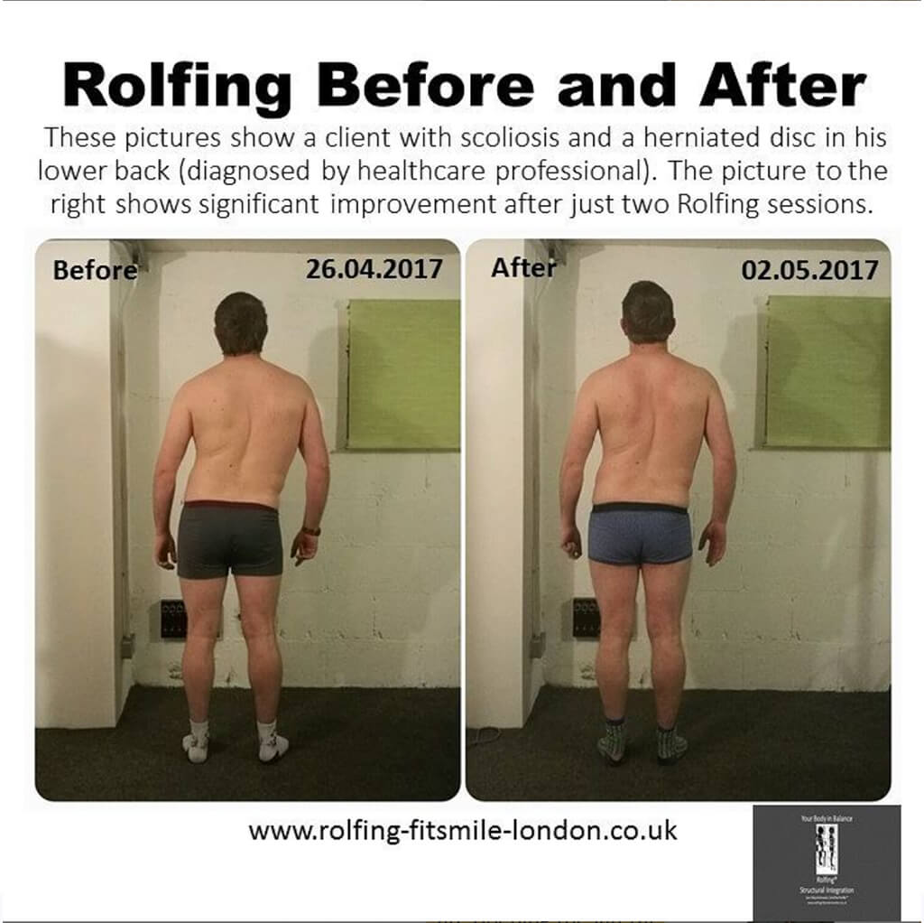 A before-and-after comparison of a man with scoliosis demonstrating how Rolfing Therapy can drastically improve the condition.